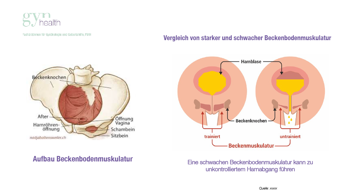 stress urinary incontinence