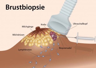 Brustkrebsvorsorge