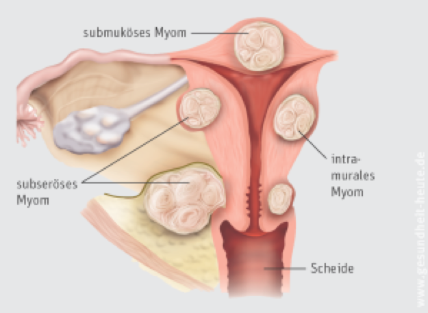 Uterus Myomatosus